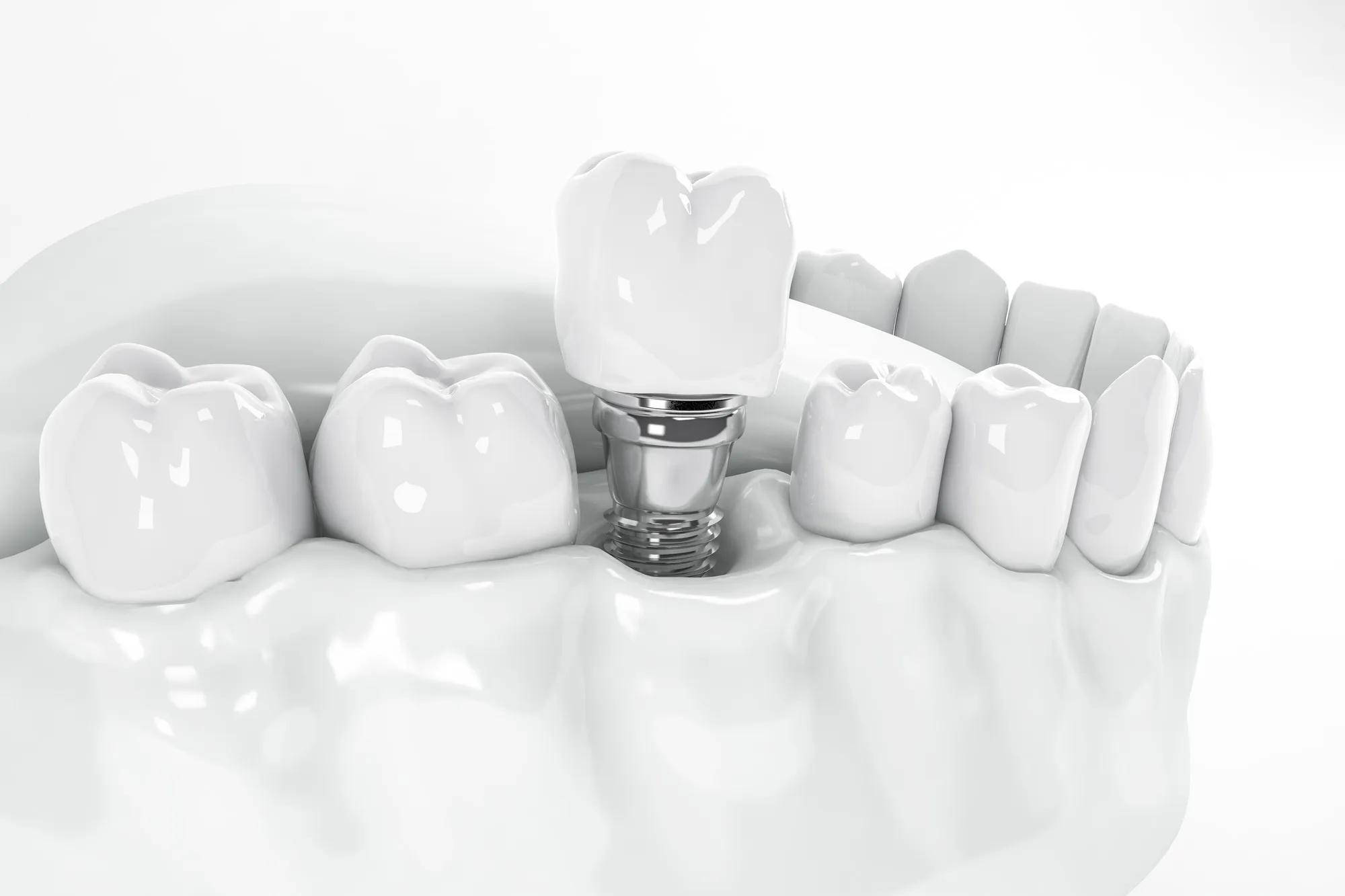 Oral Health and Dental Implants: How They Can Improve Your Life? 