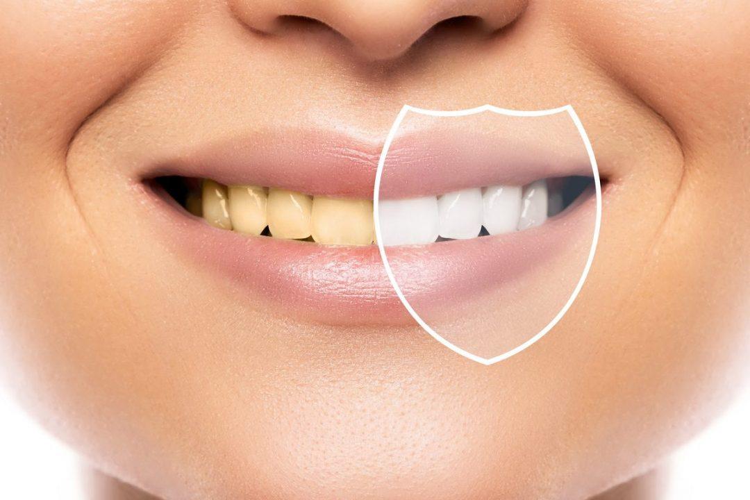 Pros and Cons of Teeth Whitening