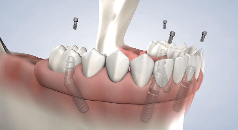 What Are All-On-Four Dental Implants And Is It A Good Option?
