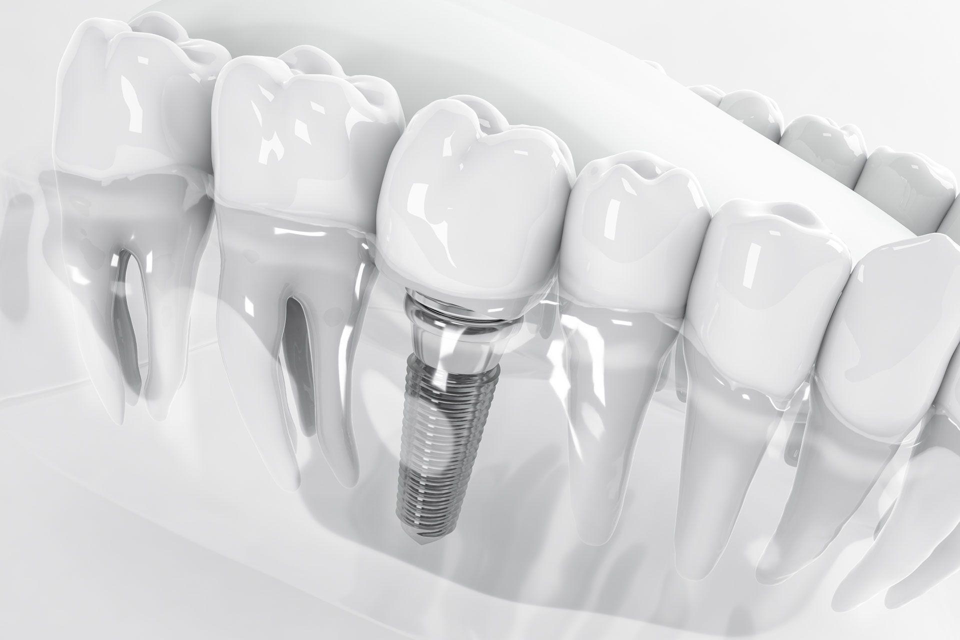 Cost-of-Dental-Implants.jpg