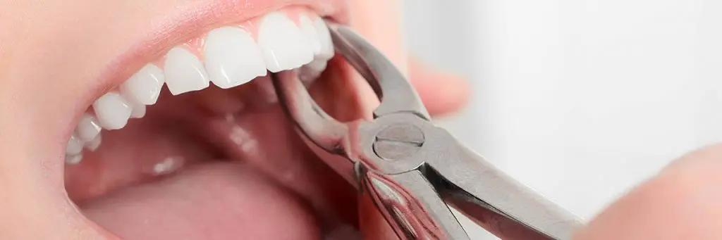 Why is Tooth Extraction Needed?