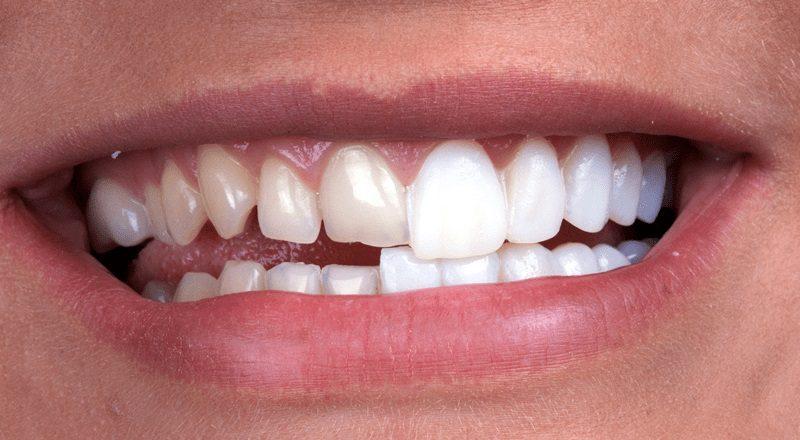 How Long Does a Dental Veneer Treatment Take?