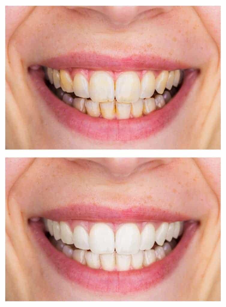 before-after-teeth-whitening-753x1024.jpeg