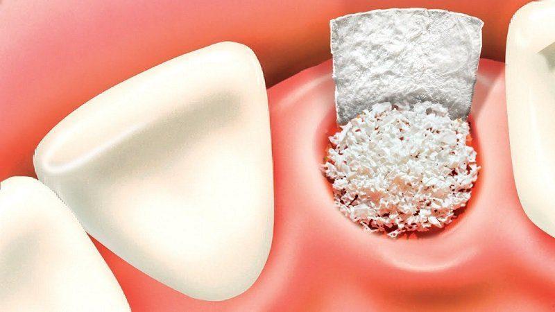 What Is A Bone Graft In Dentistry?