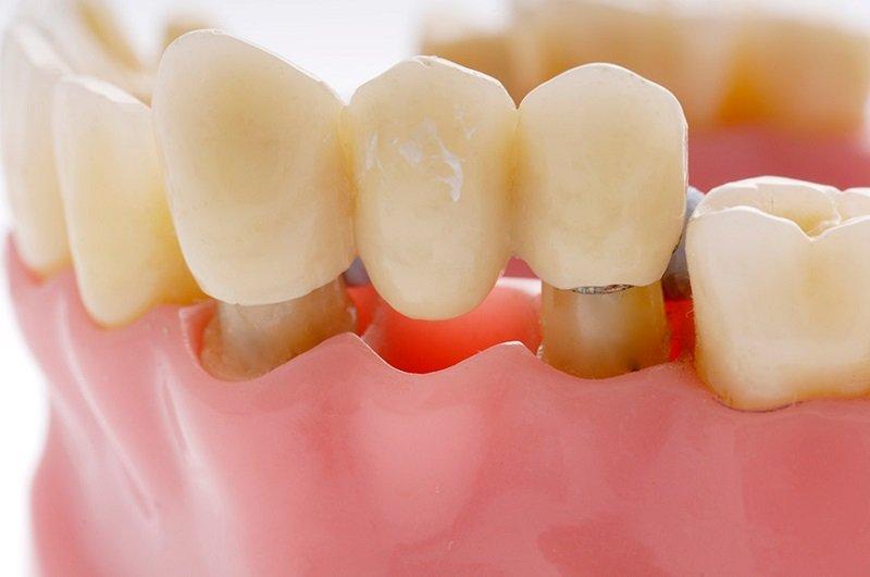 Dental Bridges vs Partial Dentures