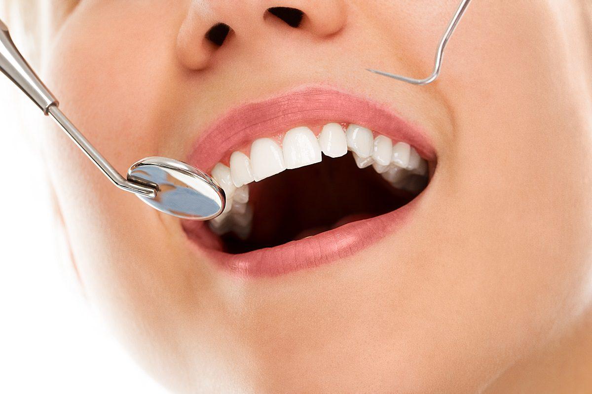 Benefits Of Dental Veneers