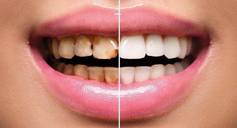 Full Mouth Reconstruction – Know The Options
